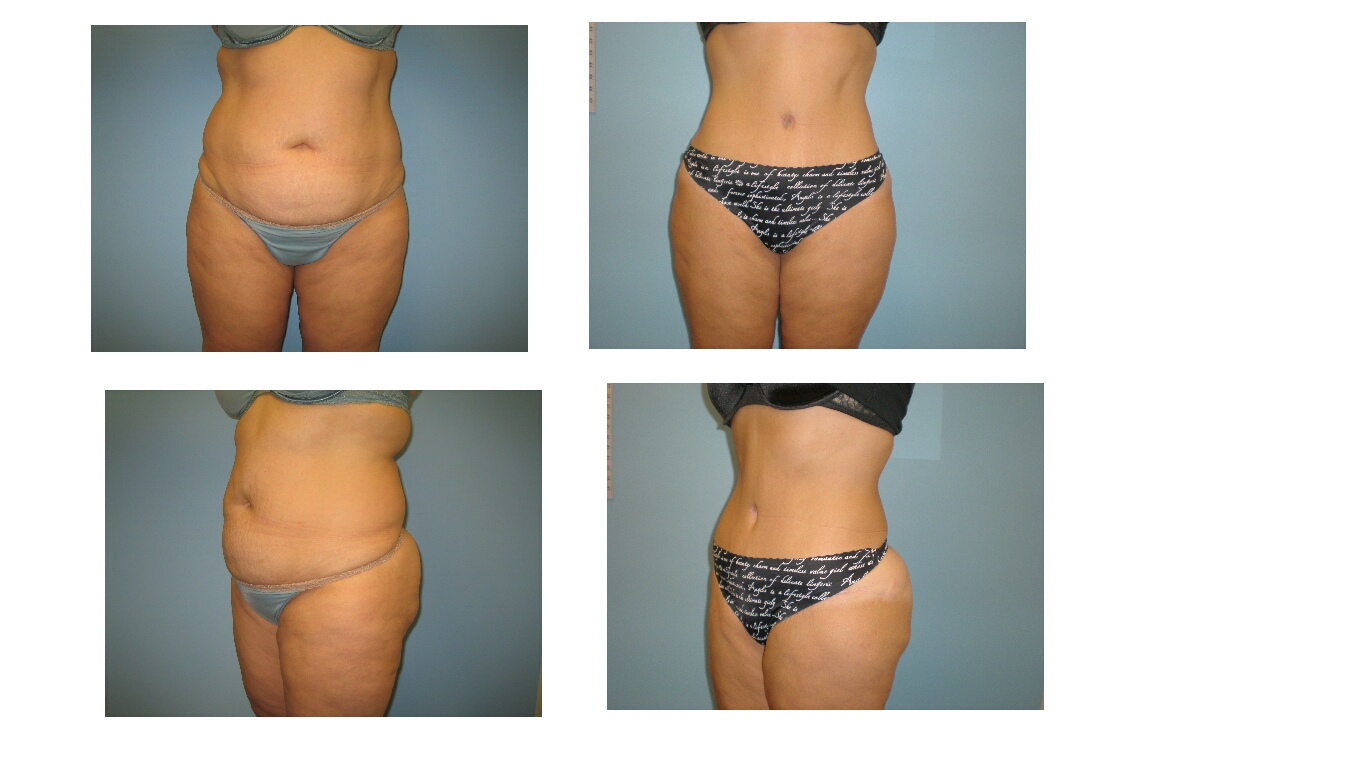 Decreased swelling after tummy tuck