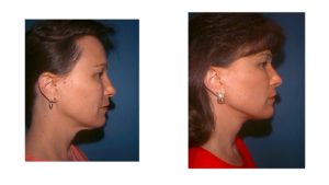 Cosmetic surgery of the neck in woman