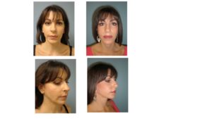 Younger woman with facelift surgery result