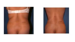 Liposuction back fat before after