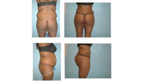 BBL Brazilian buttock lift abdominoplasty fat injection