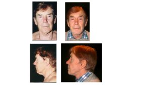 Secondary facelift result in man