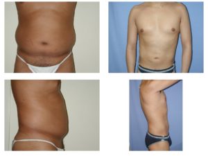 Liposuction belly and love handles in man 2 views
