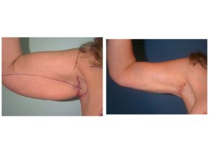 Arm Lift Before & After axillary scar