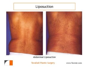 Hip love handle liposuction result in man
