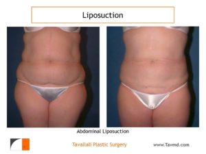 Lipo abdomen before after in woman in Northern Virginia