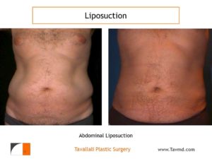 Liposuction surgery of man's abdomen before after Northern Virginia