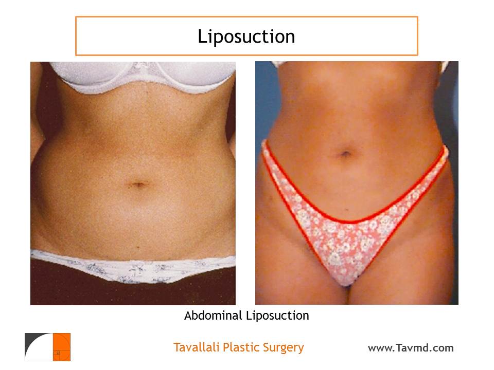 Liposuction of abdomen-360 lipo