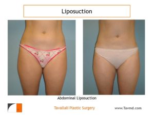 Abdominal liposuction surgery in woman