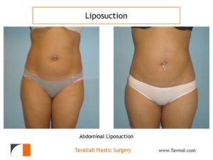 Liposuction surgery of abdomen result before after