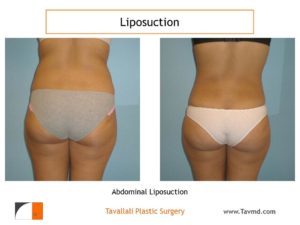 Liposuction of hips result in woman