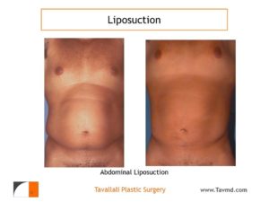 Liposuction belly and love handles in man