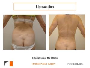 liposuction surgery of hip
