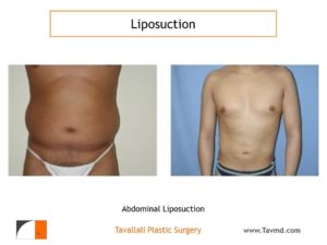 Liposuction of abdomen before and after