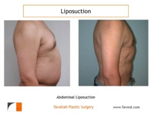 Profile of liposuction of chest and abdomen in man