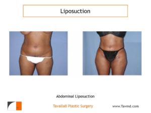 Woman before after liposuction abdomen