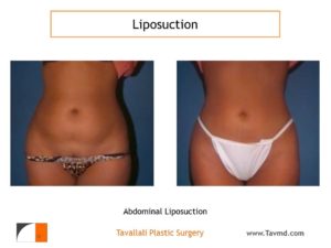 Liposuction abdomen before & after Vienna Va