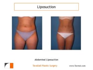 Abdomen and outer thigh lipo result