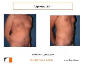 Liposuction abdomen and chest in man before after
