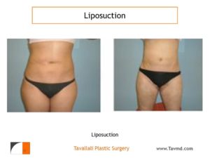 Liposuction surgery of abdomen