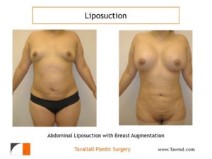 Lipo of abdomen in woman