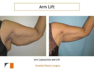Arm Liposuction and lift Before & After