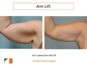 Arm Lift Before & After with early scar