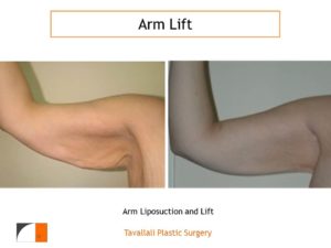 Arm Lift surgery before and after