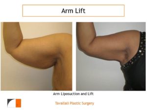 Arm Lift results with liposuction and axillary scar