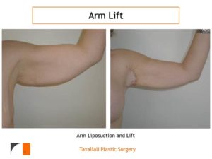 Arm Lift and Liposuction before after