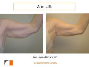 Arm Liposuction and Lift early result