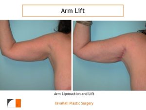 Arm Lift Before & After with axillary scar