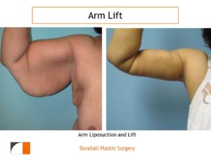 Arm Lift Plastic Surgery before after result