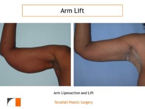 Before and After Arm Lift with scar in axilla