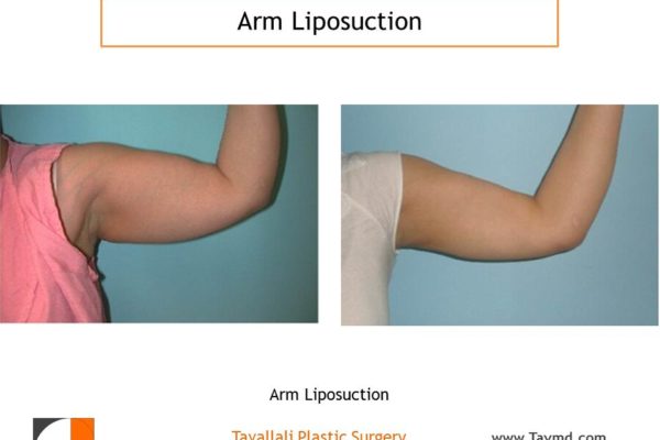 Arm liposuction result