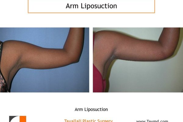 Arm liposuction result