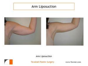 Lipo of arms before after surgery Fairfax county VA