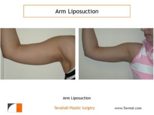 Lipo of arms before after surgery