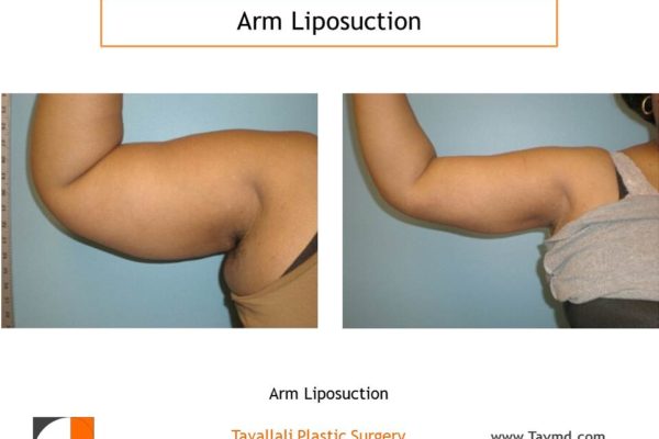 liposuction arms before & after photos Vienna VA