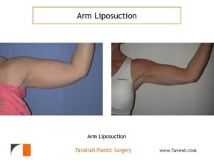 Lipo of arms before after surgery