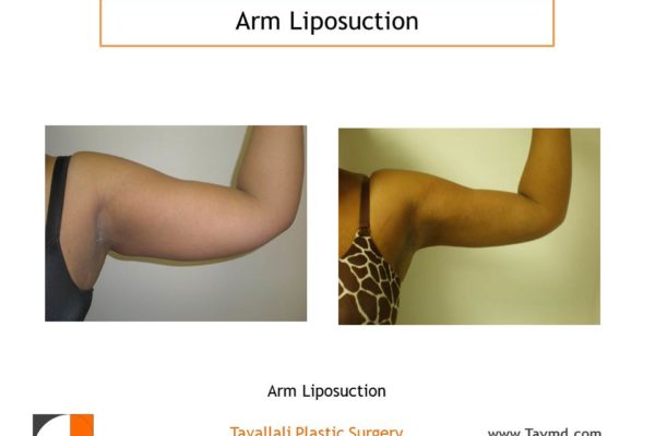 Arm liposuction result before & after
