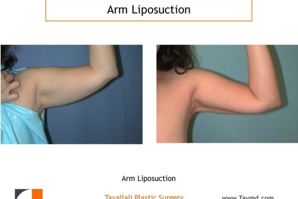 liposuction surgery arms before after Fairfax county VA