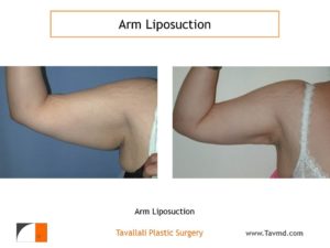 liposuction surgery arms before after Tyson's corner VA