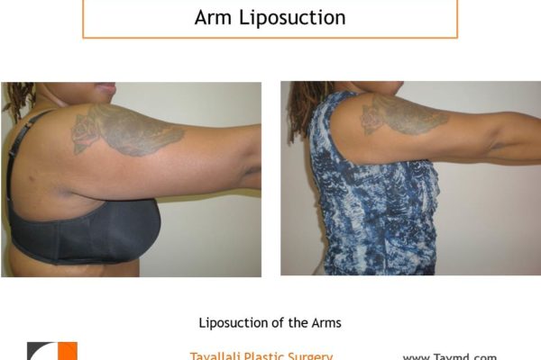 liposuction surgery arms before after