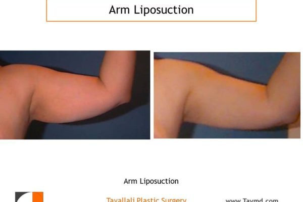 liposuction surgery arms before after Virginia