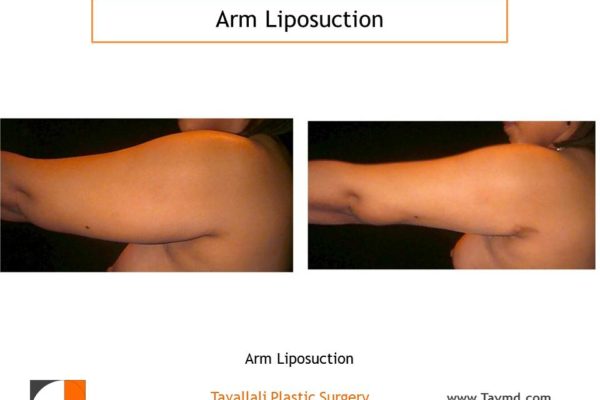 side view of liposuction surgery arms before after