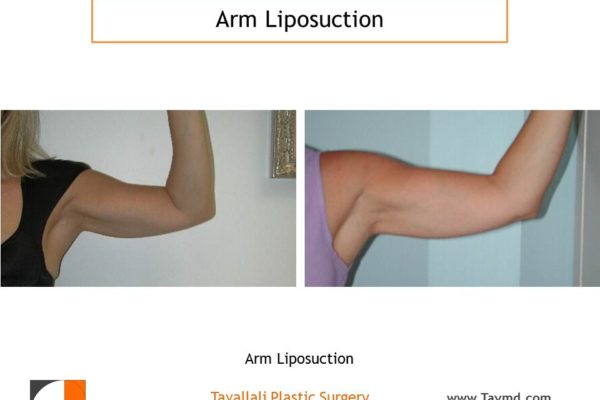 liposuction surgery arms before after woman