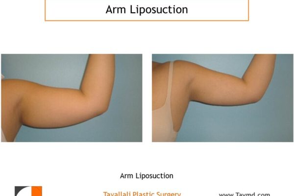 Arm Liposuction29