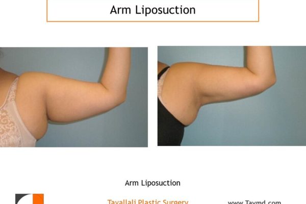 lipo arms before after