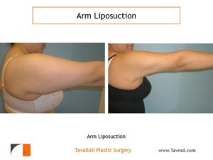 liposuction surgery arms before after side view